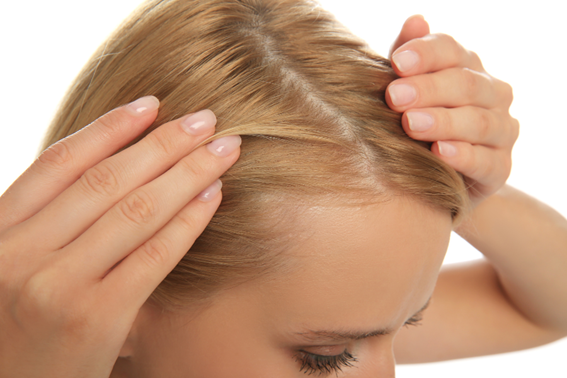 Todo lo que debes saber sobre la alopecia femenina 