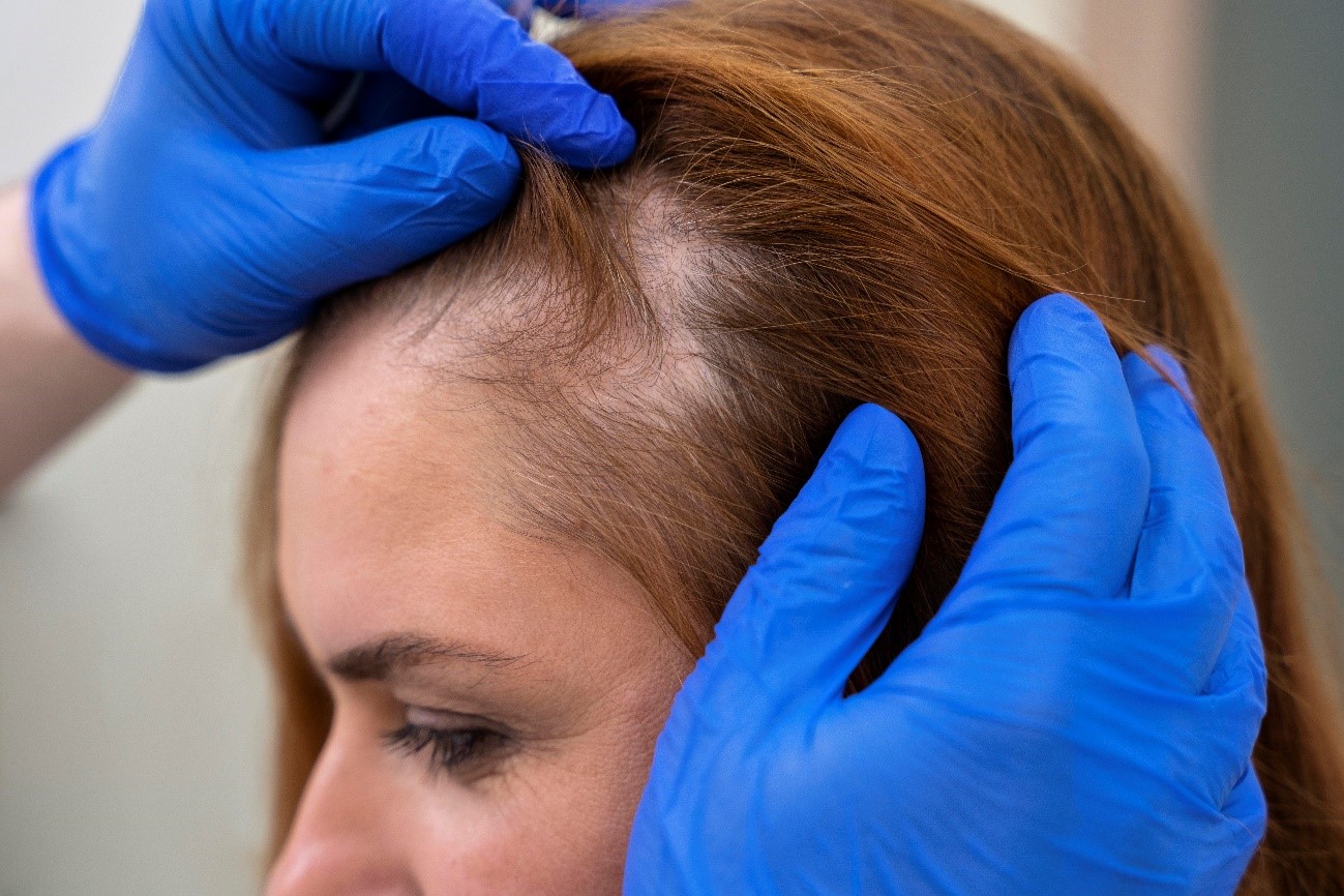 Todo lo que debes saber sobre la alopecia areata 